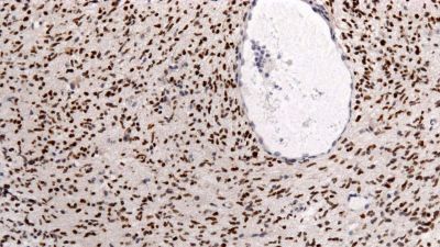 Rózsaszínen fénylő rákos sejtek könnyíthetik meg a sebészek dolgát