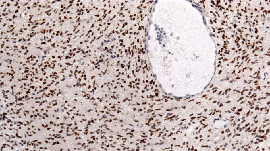 Rózsaszínen fénylő rákos sejtek könnyíthetik meg a sebészek dolgát